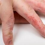 Причины раздражения между пальцами рук и лечение